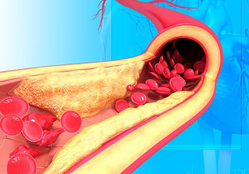 Tăng cholesterol máu cảnh báo mắc các bệnh gì: Bác sĩ BV Bạch Mai chỉ ra những căn bệnh quen thuộc, nhưng rất nguy hiểm cho sức khỏe